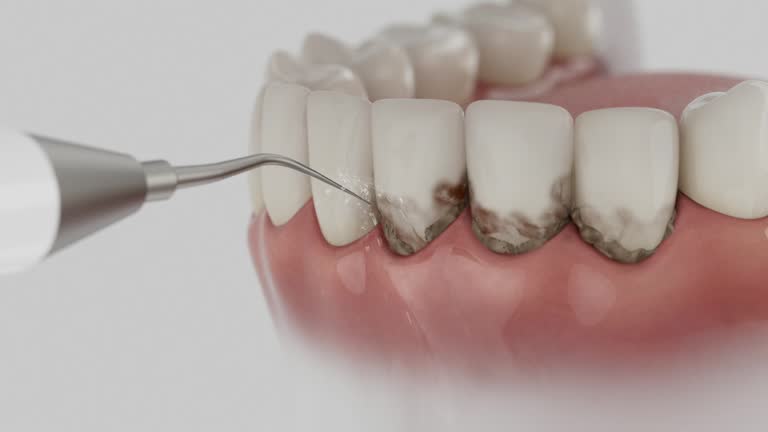 Reliable Wisdom Tooth Removal contractor in Lewis County County, ID by Dentist Open Now
